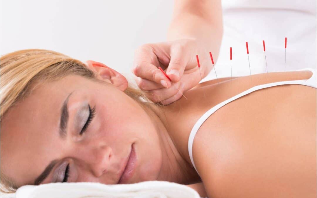 Licensed Acupuncturist vs. Dry Needling Practitioners: Key Differences in Training and Safety